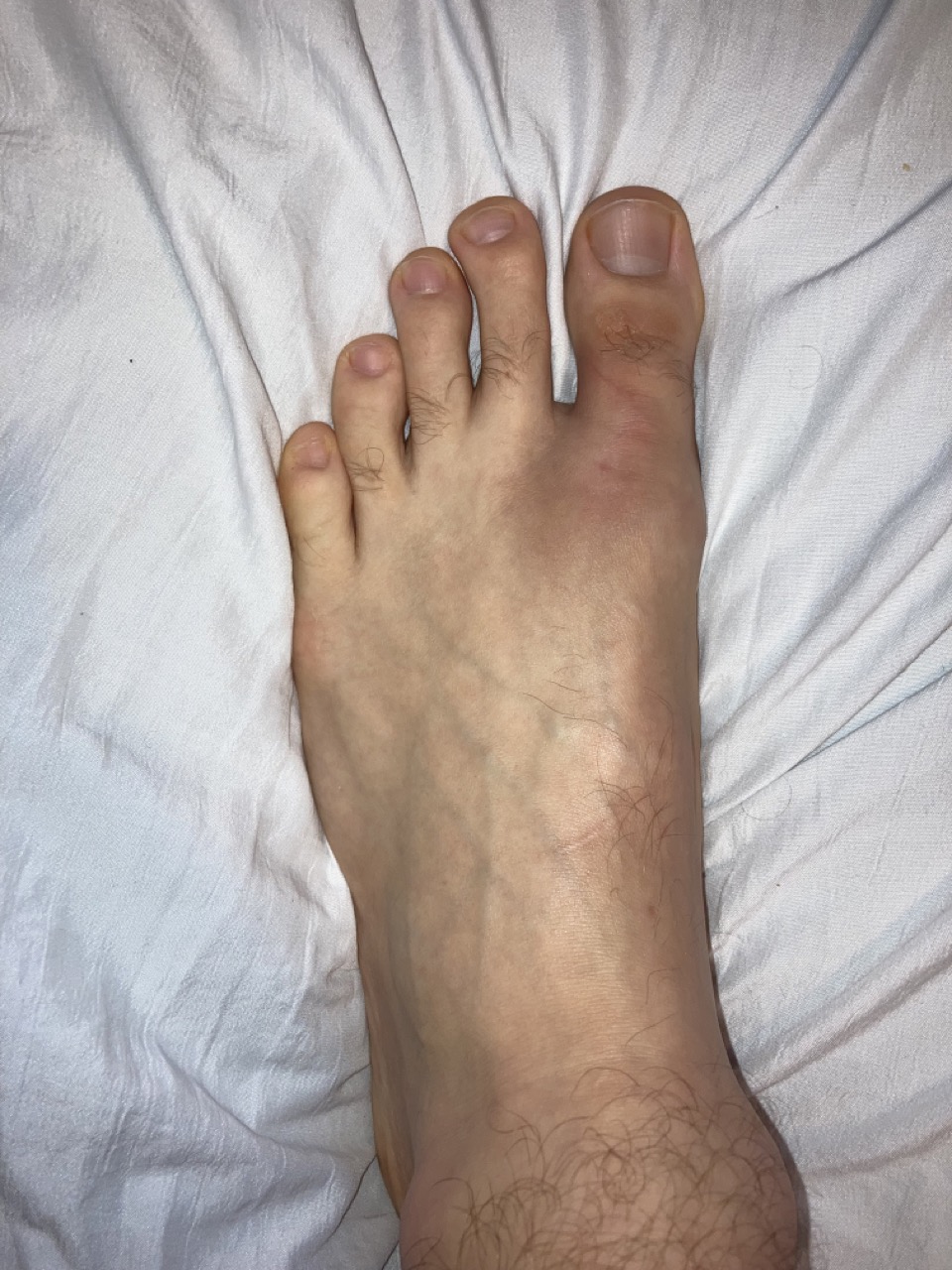 Natural Bunion Reversal in 5 Steps